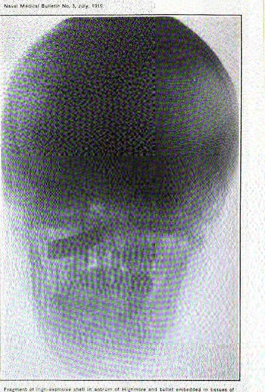 This image is taken from United States Naval Medical Bulletin Vol. 13, Nos. 1-4, 1919